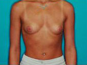 Patient # 30505 Before Photo # 1